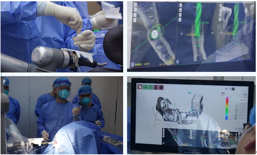 2022年8月，雅悦齿科总院长王杰带领团队完成首例口腔机器人种植手术。